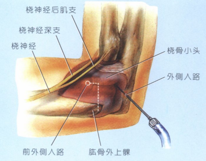 关节镜治疗关节炎