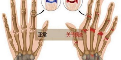 类风湿用什么药最好 哪种方法最有效