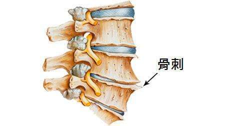 骨刺治疗