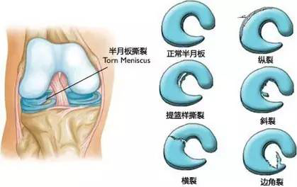 半月板撕裂