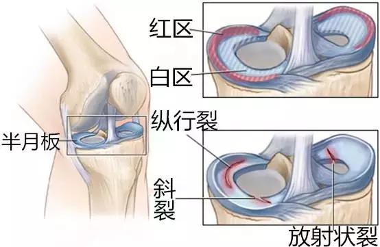 半月板Ⅱ度损伤