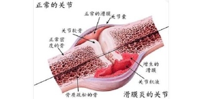 滑膜炎