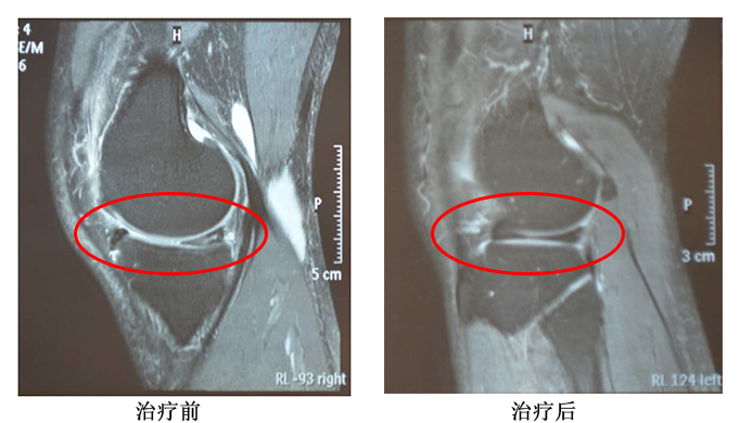 半月板撕裂治疗对比