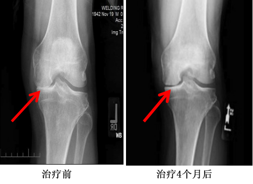 关节退变治疗对比