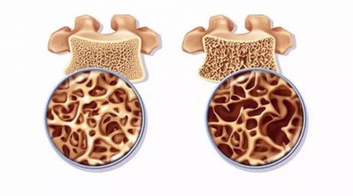 骨质疏松骨关节炎