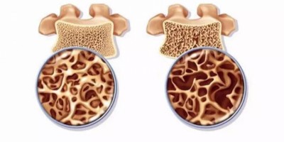 骨质疏松骨关节炎