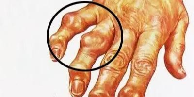 手指骨关节炎