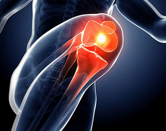 骨性关节炎多发于膝关节
