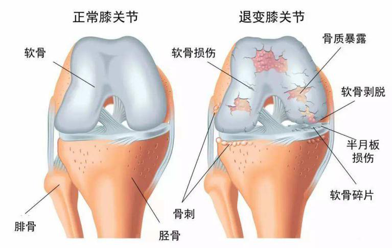 为什么年轻人也会关节退变