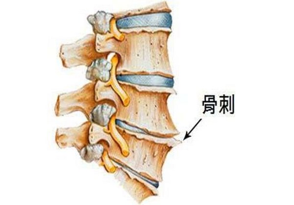 骨质增生