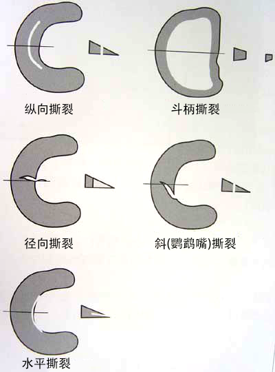 半月板损伤