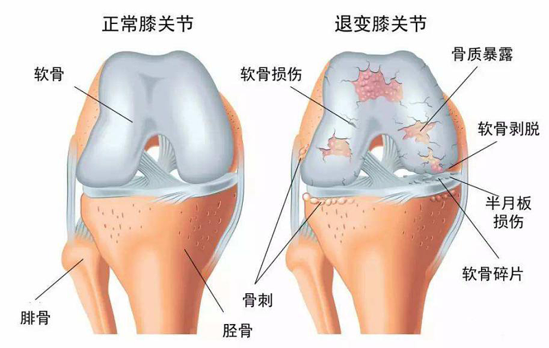 退行性关节炎