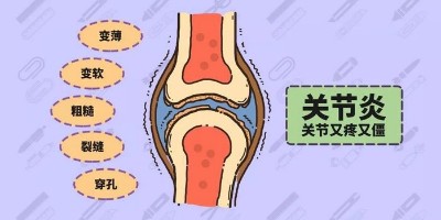 膝关节炎