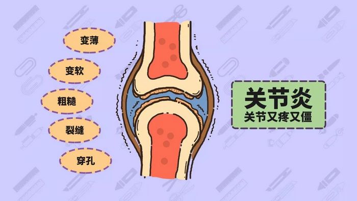膝关节炎会不会影响寿命,这个问题不容小觑