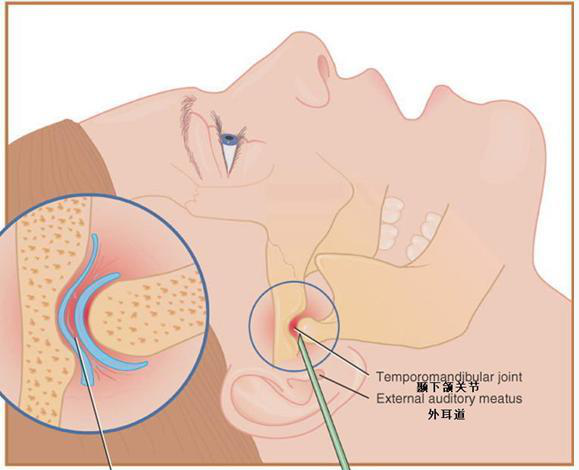 颞下颌关节炎