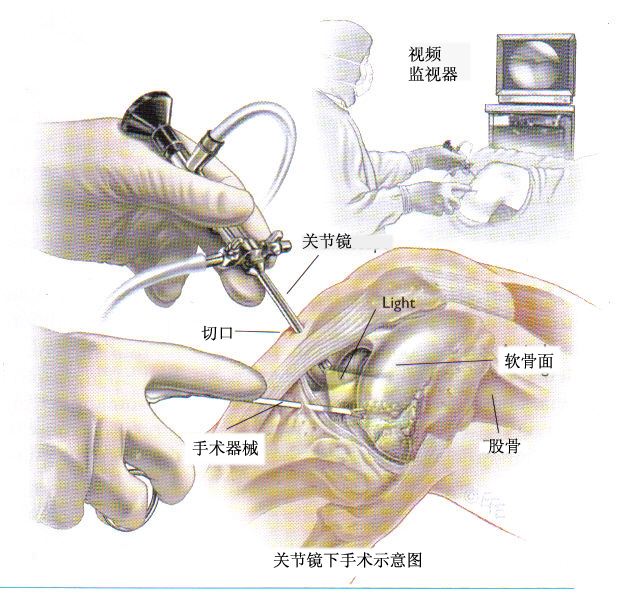 腿友之家：做关节修复注射必须结合关节镜吗？