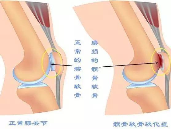 髌骨软化症