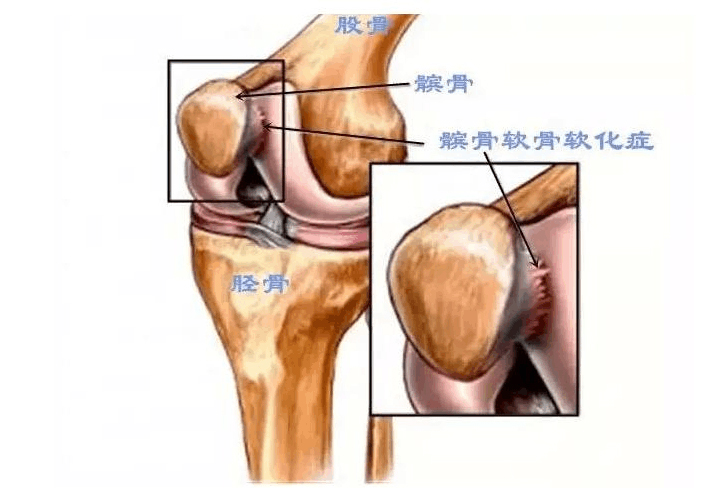 髌骨软化症