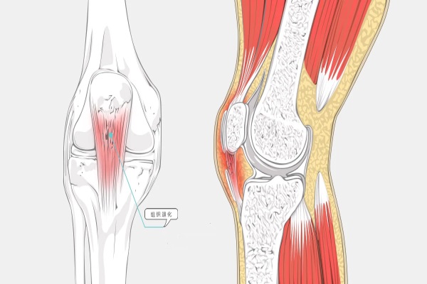 肌腱炎3_副本