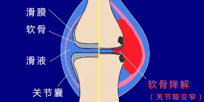 滑膜炎