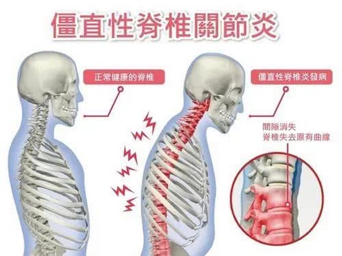 治疗强直性脊柱炎