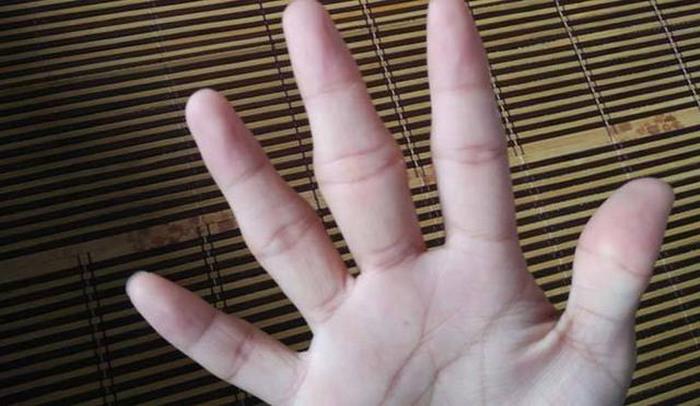 手指风湿性关节炎治疗偏方