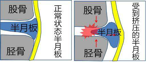 内侧半月板后角变性治疗