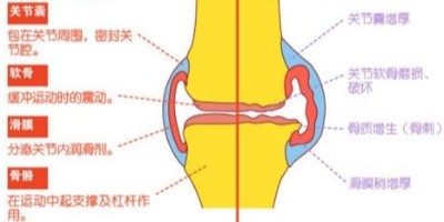 骨关节炎
