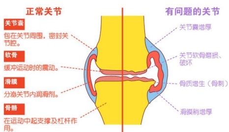 骨关节炎