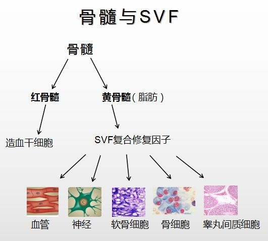 想要了解SVF，让我们从微骨折手术说起