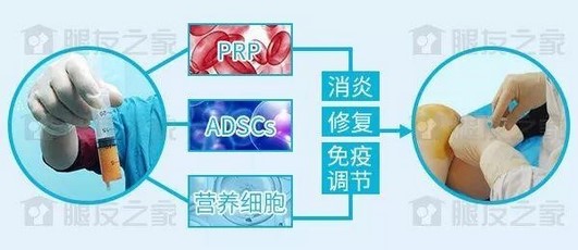 想要了解SVF，让我们从微骨折手术说起