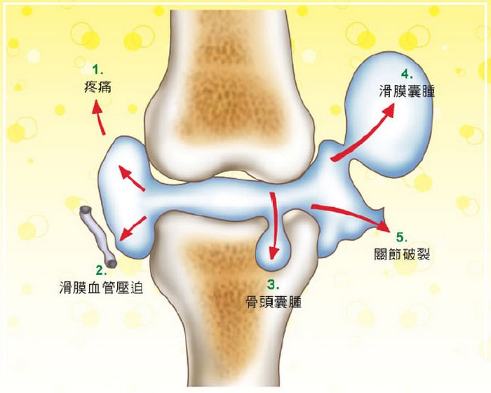 退化性关节炎