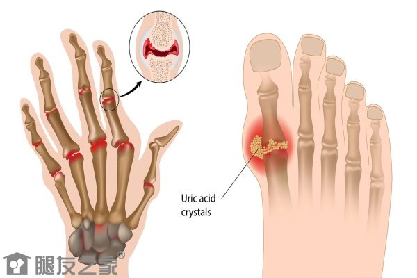 痛风性关节炎的症状有哪些.jpg