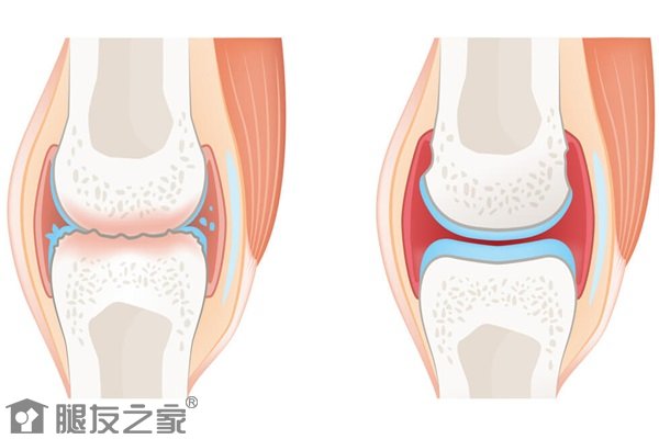 风寒性关节炎怎么治疗.jpg