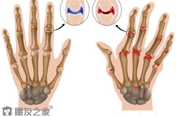 手指关节炎表现有哪些.jpg