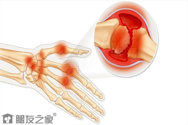 痛风和类风湿关节炎的区别是什么.jpg