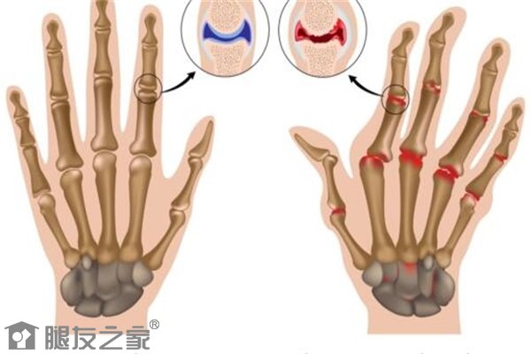 骨关节炎平时注意事项是什么.jpg
