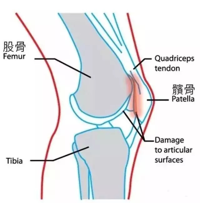 膝盖髌骨位置图片图片