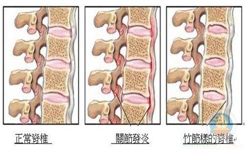 强直性脊柱炎图片对比图片