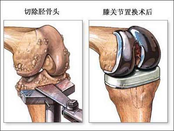 膝关节置换示意图图片