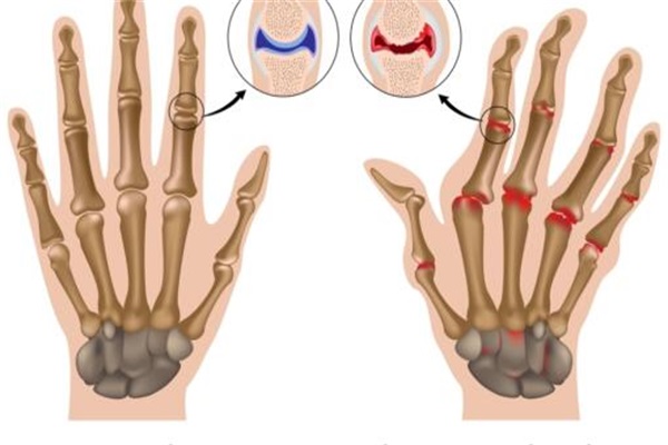 手指关节炎是怎么引起的.jpg